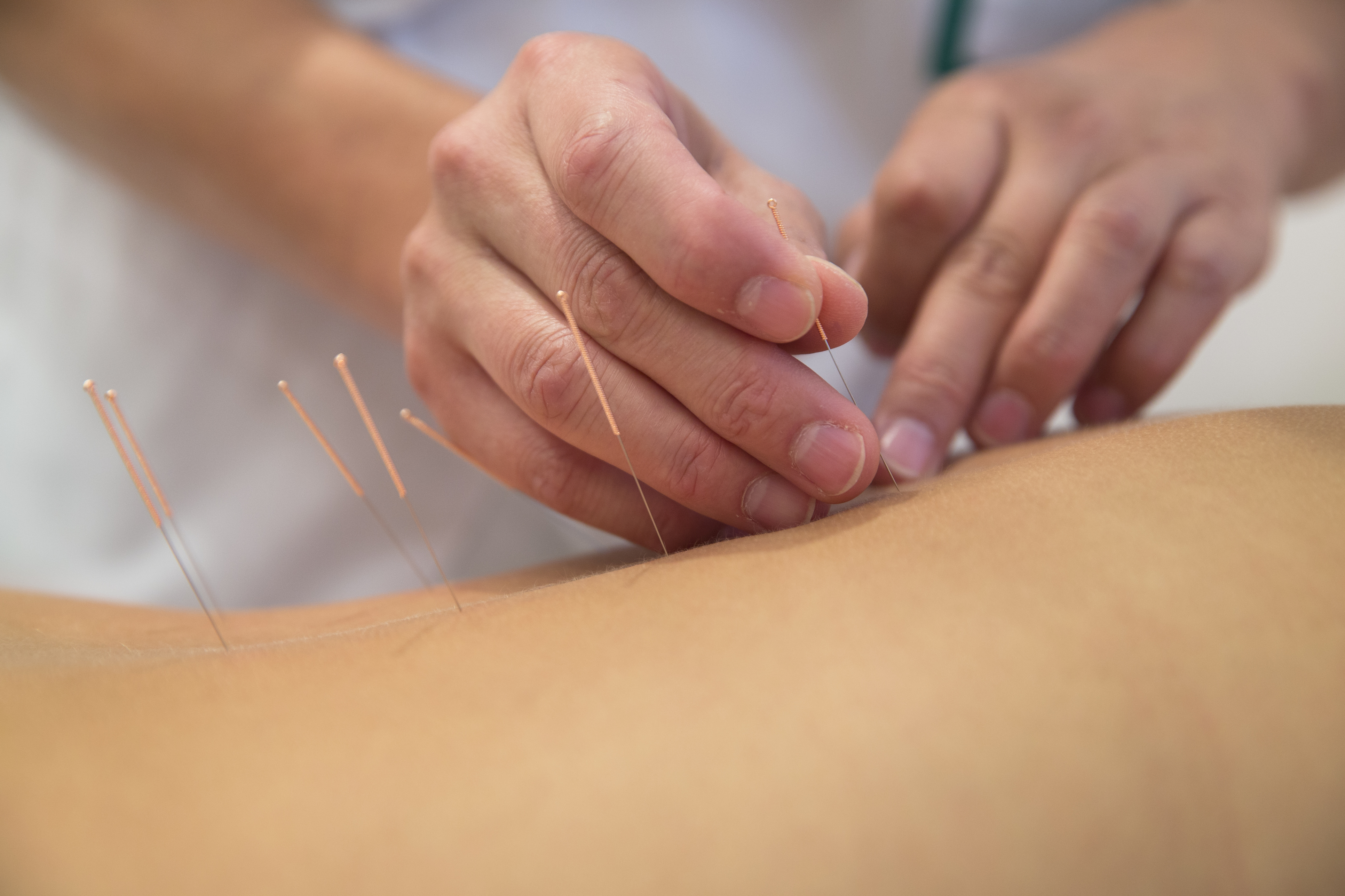 Acupuncture needles on back of a young woman